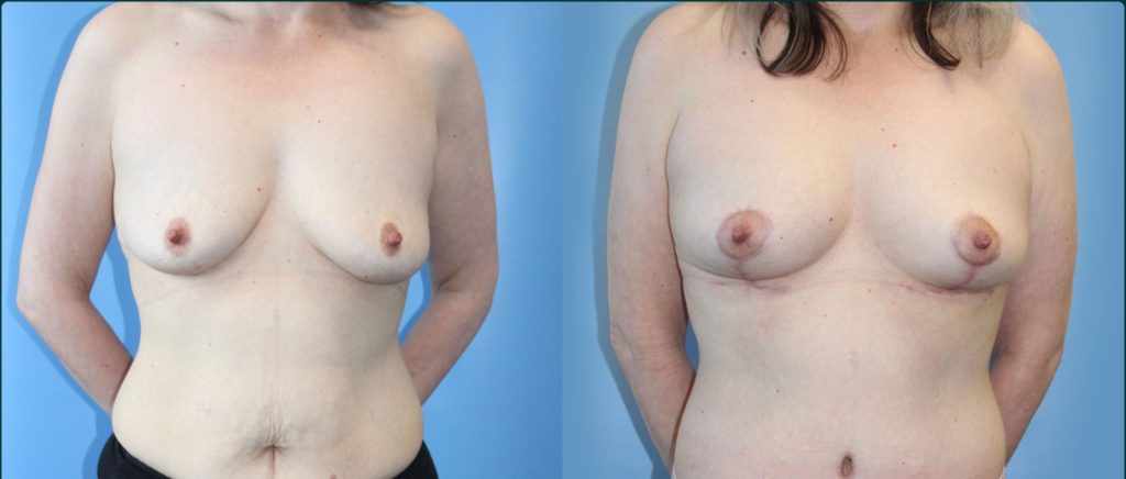 Fat grafting (fat transfer) before and after, front view, female patient, case FAT-L06, Dr Rohit Kumar, Sydney