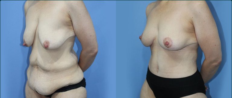 Fat grafting (fat transfer) before and after, 45° left view, female patient, case FAT-L07, Dr Rohit Kumar, Sydney