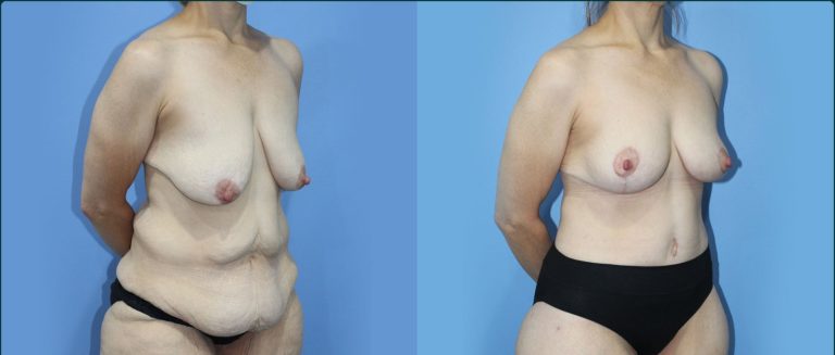 Fat grafting (fat transfer) before and after, 45° right view, female patient, case FAT-L07, Dr Rohit Kumar, Sydney