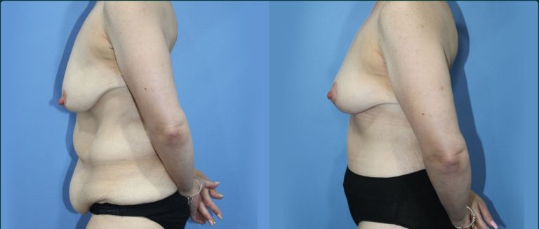 Fat grafting (fat transfer) before and after, 90° left view, female patient, case FAT-L07, Dr Rohit Kumar, Sydney