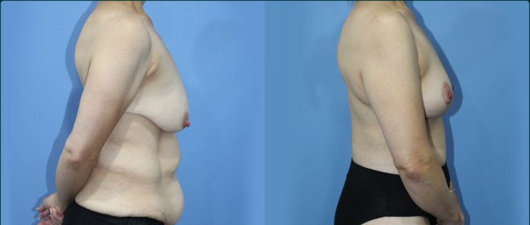 Fat grafting (fat transfer) before and after, 90° right view, female patient, case FAT-L07, Dr Rohit Kumar, Sydney
