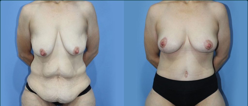 Fat grafting (fat transfer) before and after, front view, female patient, case FAT-L07, Dr Rohit Kumar, Sydney