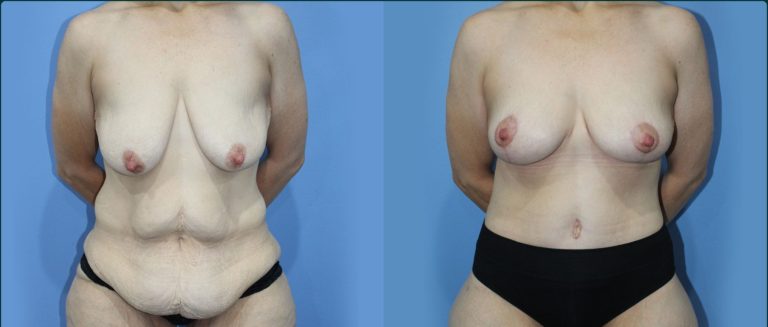 Fat grafting (fat transfer) before and after, front view, female patient, case FAT-L07, Dr Rohit Kumar, Sydney