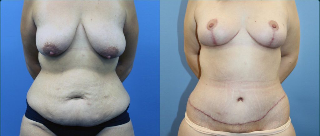 Fat grafting (fat transfer) before and after, female patient, case FAT-L08, Dr Rohit Kumar, Sydney