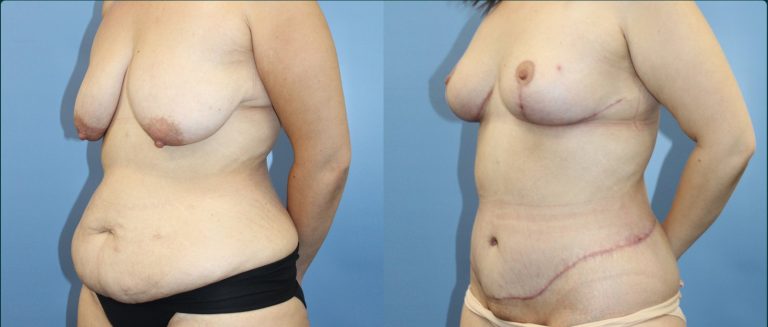 Fat grafting (fat transfer) before and after, female patient, case FAT-L08, Dr Rohit Kumar, Sydney