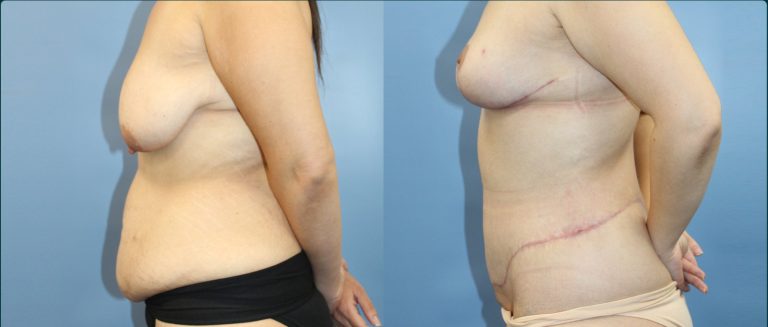 Fat grafting (fat transfer) before and after, female patient, case FAT-L08, Dr Rohit Kumar, Sydney