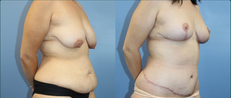 Fat grafting (fat transfer) before and after, female patient, case FAT-L08, Dr Rohit Kumar, Sydney