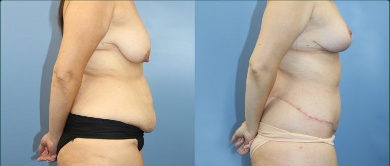 Fat grafting (fat transfer) before and after, female patient, case FAT-L08, Dr Rohit Kumar, Sydney