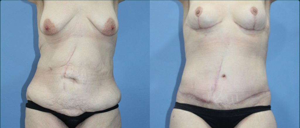 Fat grafting (fat transfer) before and after, female patient, case FAT-L09, Dr Rohit Kumar, Sydney