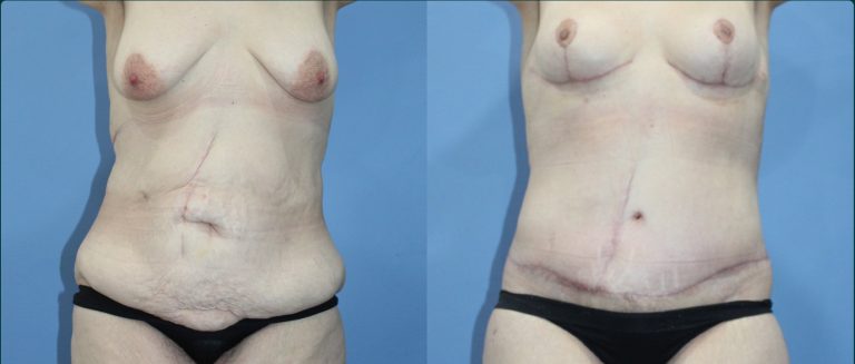 Fat grafting (fat transfer) before and after, female patient, case FAT-L09, Dr Rohit Kumar, Sydney