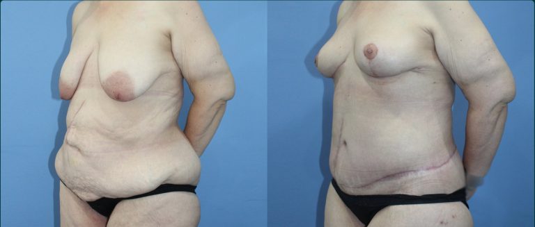 Fat grafting (fat transfer) before and after, female patient, case FAT-L09, Dr Rohit Kumar, Sydney
