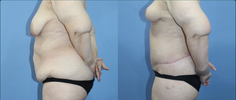 Fat grafting (fat transfer) before and after, female patient, case FAT-L09, Dr Rohit Kumar, Sydney