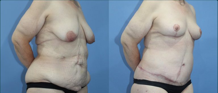Fat grafting (fat transfer) before and after, female patient, case FAT-L09, Dr Rohit Kumar, Sydney