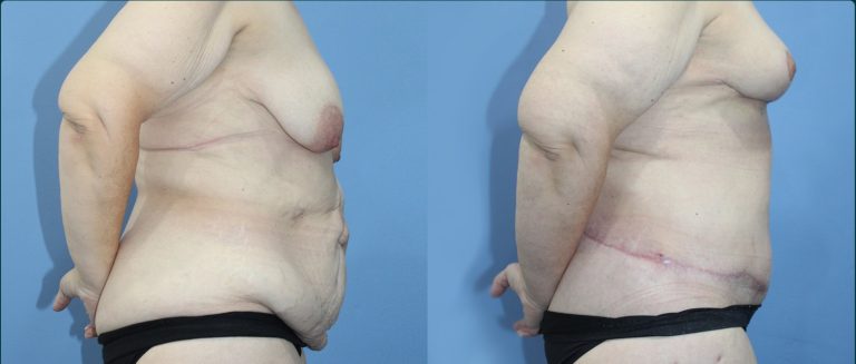 Fat grafting (fat transfer) before and after, female patient, case FAT-L09, Dr Rohit Kumar, Sydney