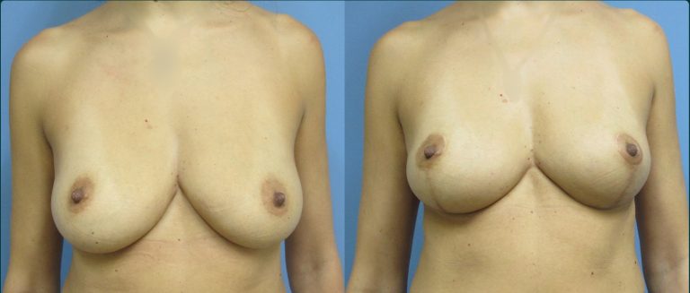 Breast lift (mastopexy) before and after, female patient, case FAT-L10, Dr Rohit Kumar, Sydney