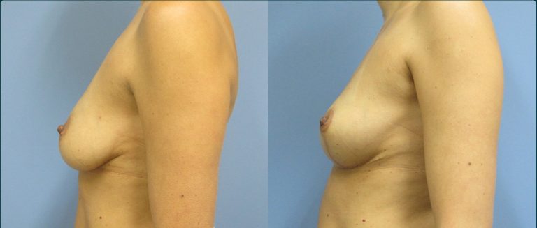 Breast lift (mastopexy) before and after, female patient, case FAT-L10, Dr Rohit Kumar, Sydney