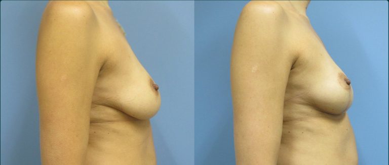Breast lift (mastopexy) before and after, female patient, case FAT-L10, Dr Rohit Kumar, Sydney