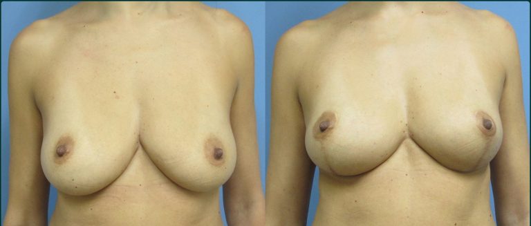 Breast lift (mastopexy) before and after, female patient, case FAT-L10, Dr Rohit Kumar, Sydney