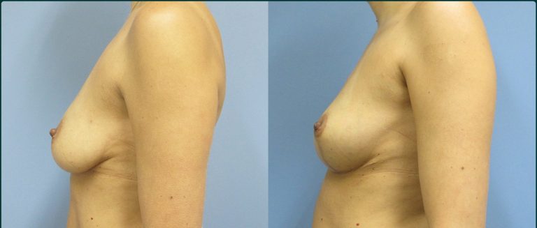 Breast lift (mastopexy) before and after, female patient, case FAT-L10, Dr Rohit Kumar, Sydney