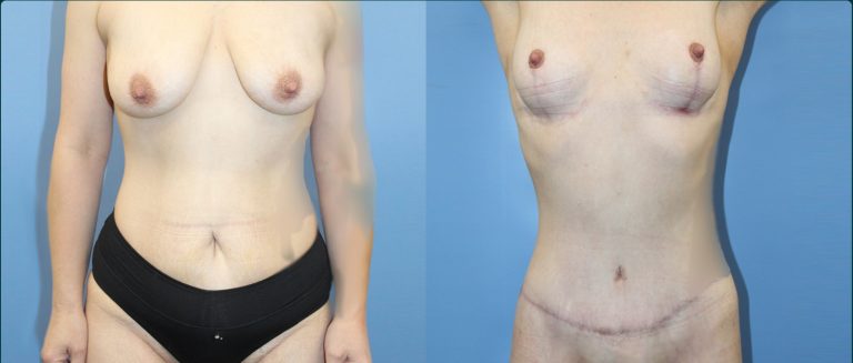 Fat grafting (fat transfer) before and after, female patient, case FAT-L11, Dr Rohit Kumar, Sydney