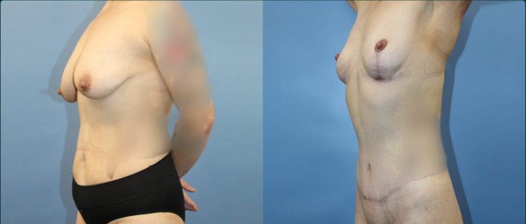 Fat grafting (fat transfer) before and after, female patient, case FAT-L11, Dr Rohit Kumar, Sydney