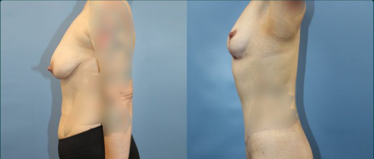 Fat grafting (fat transfer) before and after, female patient, case FAT-L11, Dr Rohit Kumar, Sydney