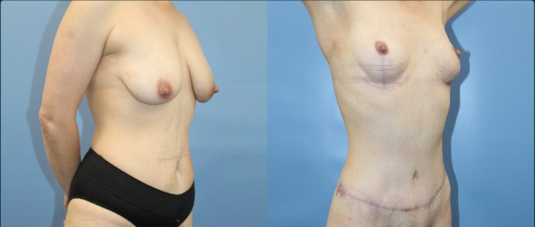 Fat grafting (fat transfer) before and after, female patient, case FAT-L11, Dr Rohit Kumar, Sydney