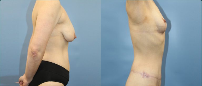 Fat grafting (fat transfer) before and after, female patient, case FAT-L11, Dr Rohit Kumar, Sydney