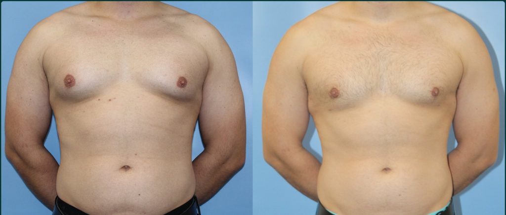 Gynaecomastia (male breast reduction) before and after, male patient, case GYN-L01, Dr Rohit Kumar, Sydney