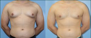 Penrith 9 Gynaecomastia before and after, front view, case GYN-L01, Dr Rohit Kumar