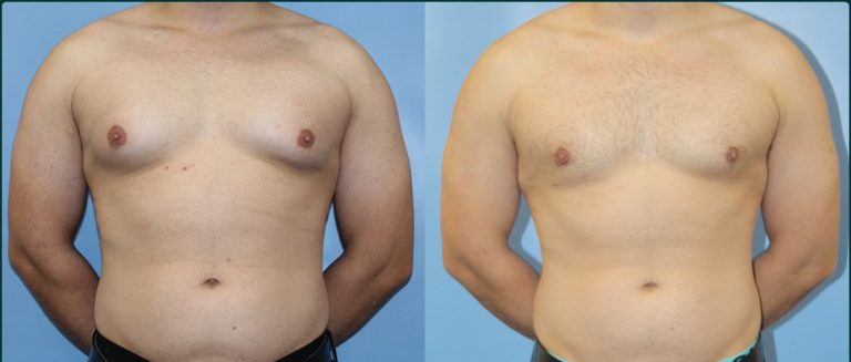Gynaecomastia (male breast reduction) before and after, male patient, case GYN-L01, Dr Rohit Kumar, Sydney