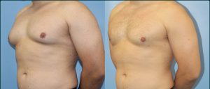 Penrith 10 Gynaecomastia before and after, 45° view, case GYN-L01, Dr Rohit Kumar