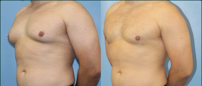 Gynaecomastia (male breast reduction) before and after, male patient, case GYN-L01, Dr Rohit Kumar, Sydney