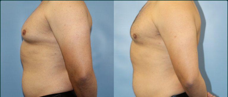 Gynaecomastia (male breast reduction) before and after, male patient, case GYN-L01, Dr Rohit Kumar, Sydney