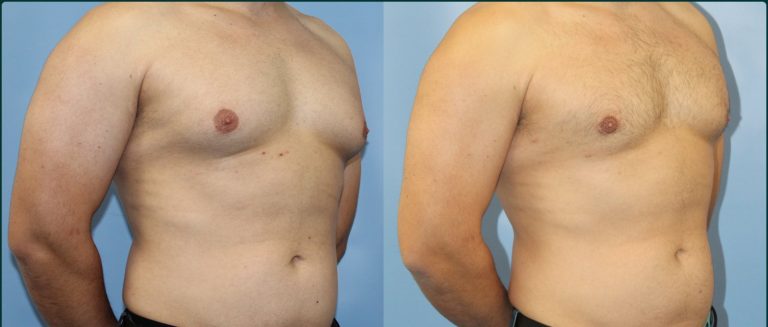 Gynaecomastia (male breast reduction) before and after, male patient, case GYN-L01, Dr Rohit Kumar, Sydney