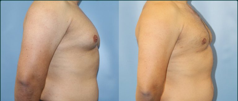Gynaecomastia (male breast reduction) before and after, male patient, case GYN-L01, Dr Rohit Kumar, Sydney