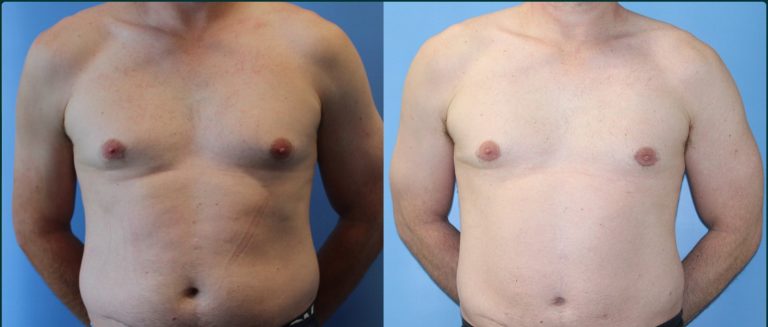 Gynaecomastia (male breast reduction) before and after, male patient, case GYN-L02, Dr Rohit Kumar, Sydney