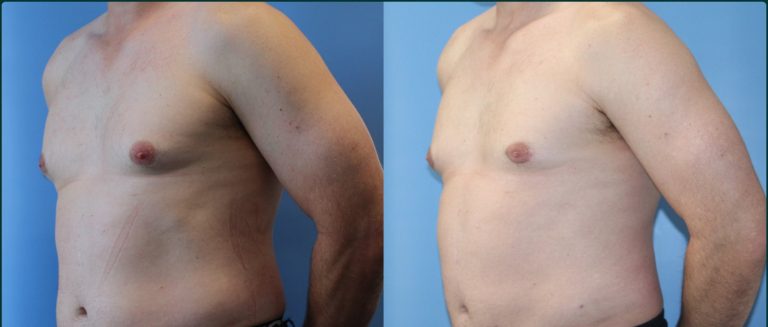 Gynaecomastia (male breast reduction) before and after, male patient, case GYN-L02, Dr Rohit Kumar, Sydney