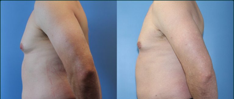 Gynaecomastia (male breast reduction) before and after, male patient, case GYN-L02, Dr Rohit Kumar, Sydney