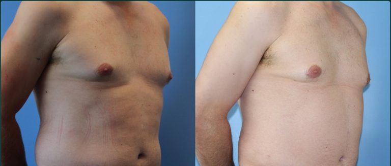 Gynaecomastia (male breast reduction) before and after, male patient, case GYN-L02, Dr Rohit Kumar, Sydney