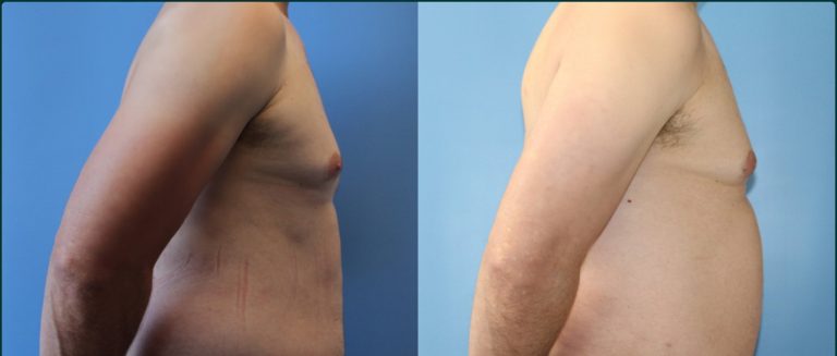 Gynaecomastia (male breast reduction) before and after, male patient, case GYN-L02, Dr Rohit Kumar, Sydney