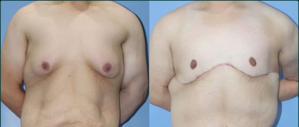 Gynaecomastia (male breast reduction) before and after, male patient, case GYN-L03, Dr Rohit Kumar, Sydney