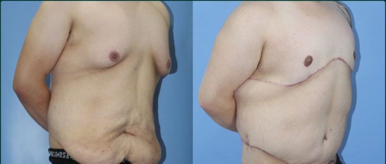 Gynaecomastia (male breast reduction) before and after, male patient, case GYN-L03, Dr Rohit Kumar, Sydney