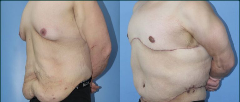 Gynaecomastia (male breast reduction) before and after, male patient, case GYN-L03, Dr Rohit Kumar, Sydney