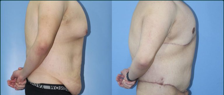 Gynaecomastia (male breast reduction) before and after, male patient, case GYN-L03, Dr Rohit Kumar, Sydney