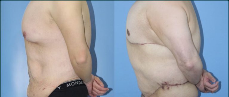 Gynaecomastia (male breast reduction) before and after, male patient, case GYN-L03, Dr Rohit Kumar, Sydney