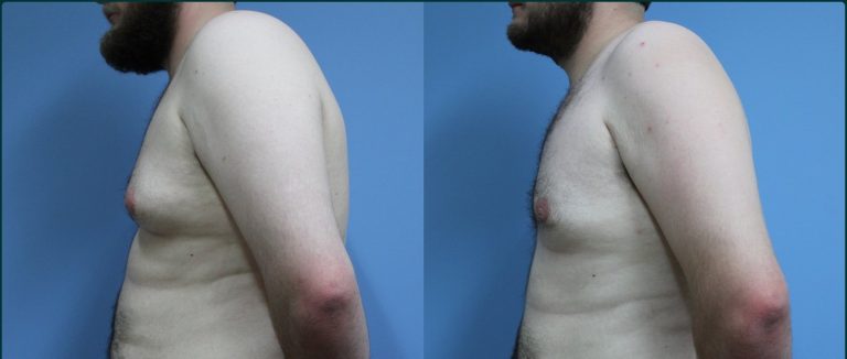 Gynaecomastia (male breast reduction) before and after, 90° left view, male patient, case GYN-L04, Dr Rohit Kumar, Sydney