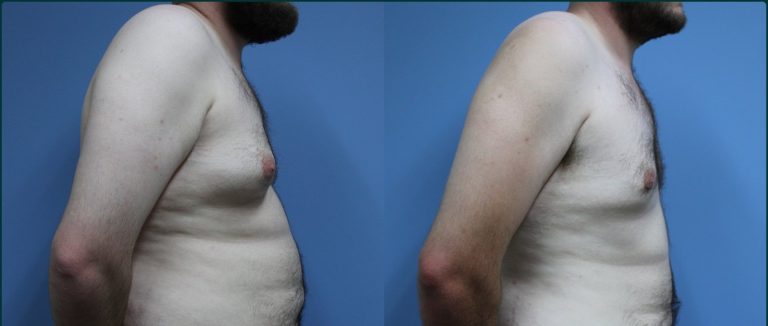 Gynaecomastia (male breast reduction) before and after, 90° right view, male patient, case GYN-L04, Dr Rohit Kumar, Sydney