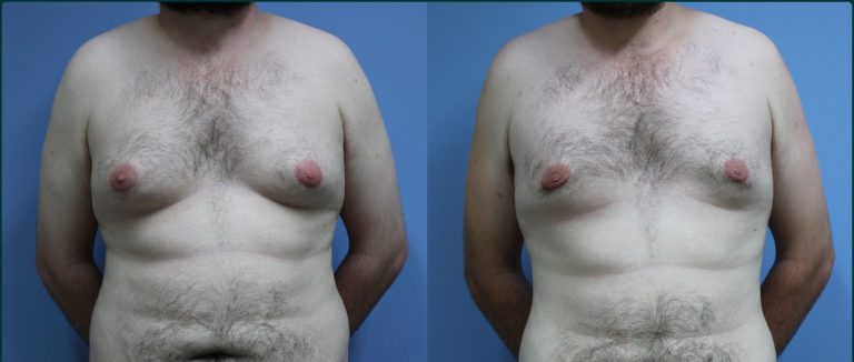 Gynaecomastia (male breast reduction) before and after, front view, male patient, case GYN-L04, Dr Rohit Kumar, Sydney