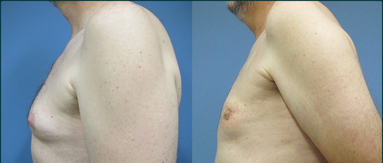 Gynaecomastia (male breast reduction) before and after, 90° left view, male patient, case GYN-L05, Dr Rohit Kumar, Sydney